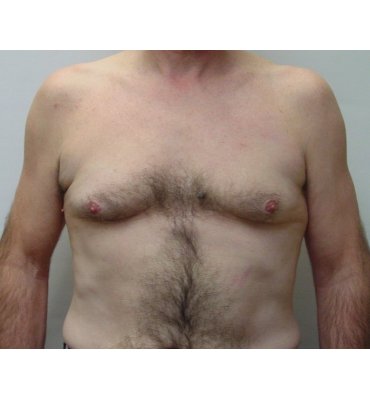 gynecomastio before